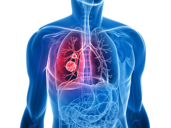 Lung_screening_IDNA